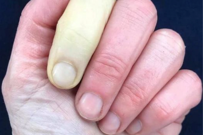Fenomeno di Raynaud: una acrosindrome