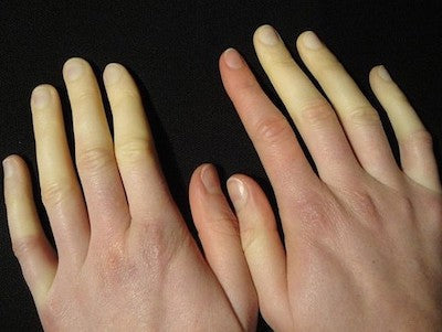 Guanti per sindrome di Raynaud: come e perché funzionano quelli NOAcademy